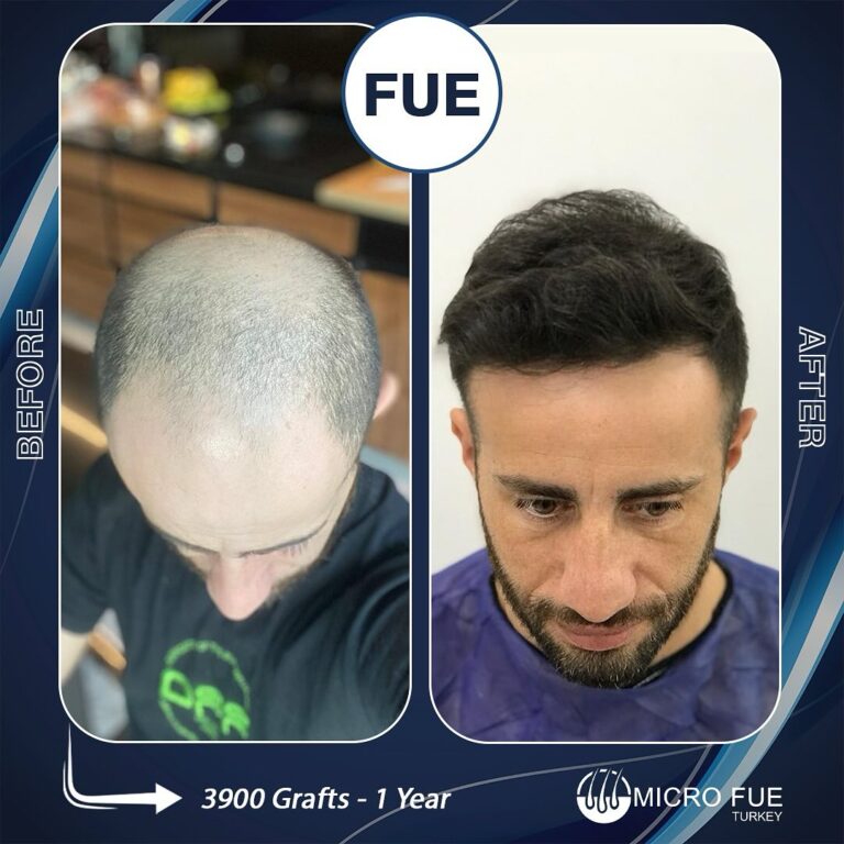 Before And After Hair Transplant Antalya