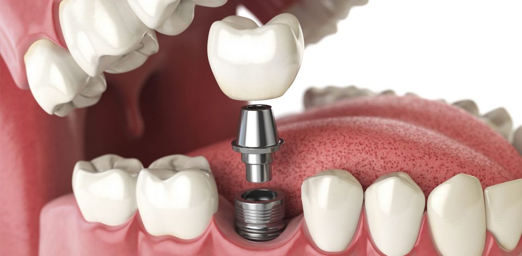 Dental Implants in Antalya