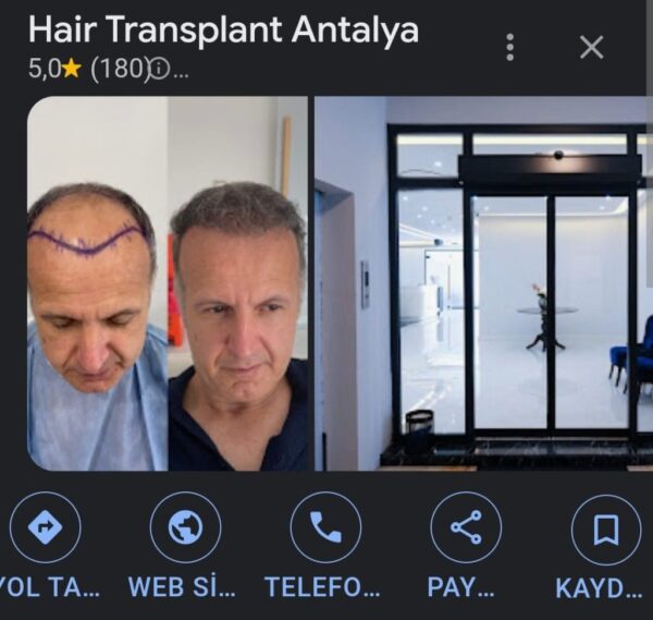 Affordable Hair Transplant in Antalya
